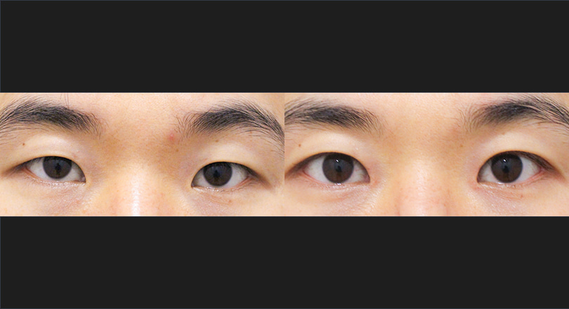 눈성형 전후사진 (자연유착, 트임)
