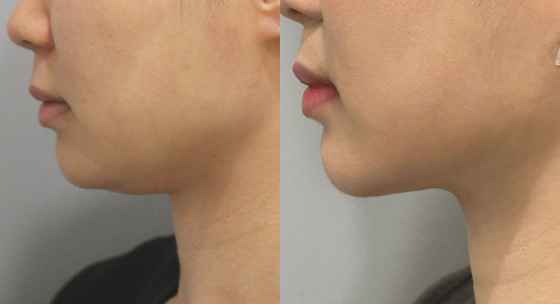 지방흡입 전후사진
