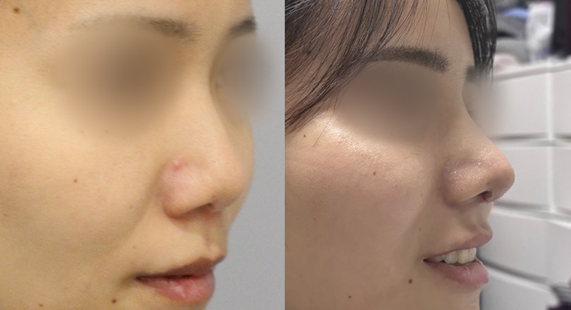 코성형 전후사진 (코성형, 짧은코교정, 비순각교정)
