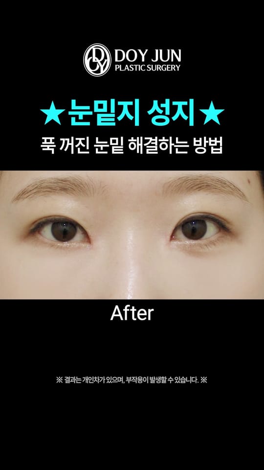 자연유착+눈매교정 수술 1개월 후