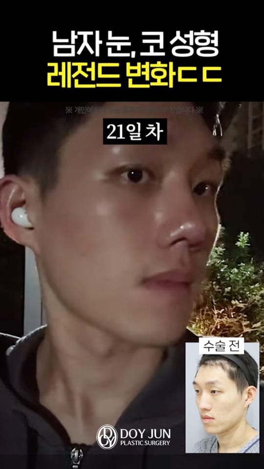 남자 눈, 코 레전드 변화